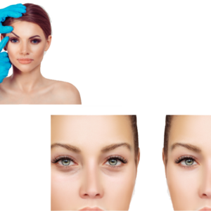 Nieinwazyjny Lifting Powiek – PLASMA