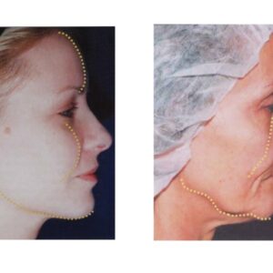 FOTONA 4D – Fotoodmładzanie skóry