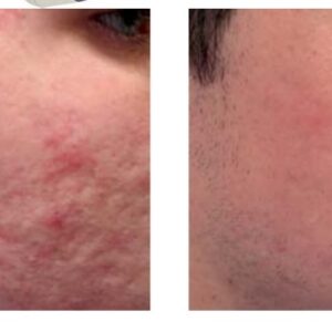 FOTONA – Leczenie trądziku i blizn potrądzikowych